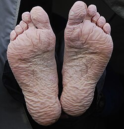 Toe web infection - Groene verkleuring P. aeruginosa